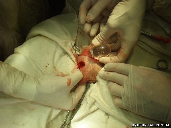Пришивание импланта к дну мошонки