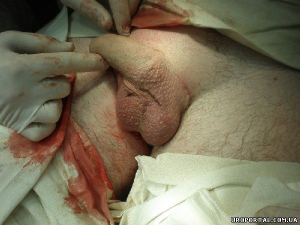 Косметический эффект после первой операции протезирования яичка слева